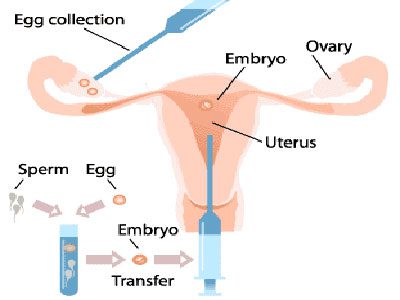 Sequential embryo transfer