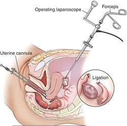 laparoscopy (1)