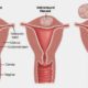 fibroid surgery cost, fibroid surgery: types, fibroid surgery in india, fibroid surgery in delhi,