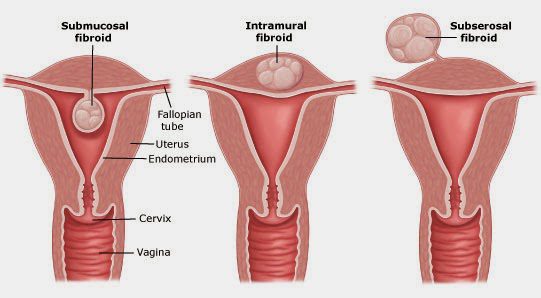fibroid surgery cost, fibroid surgery: types, fibroid surgery in india, fibroid surgery in delhi,